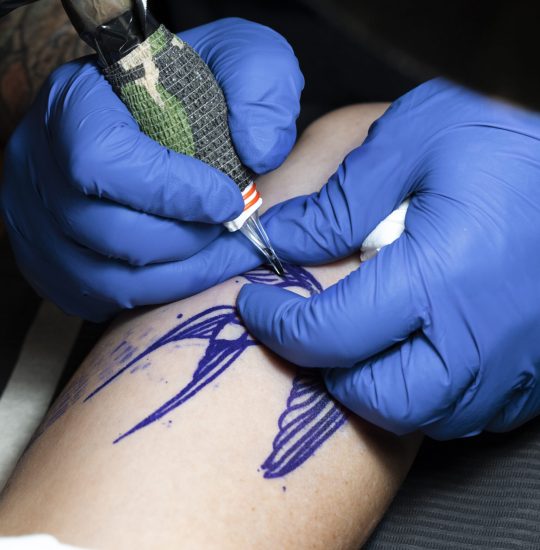 Laser Tattoo Removal in Columbia, MD