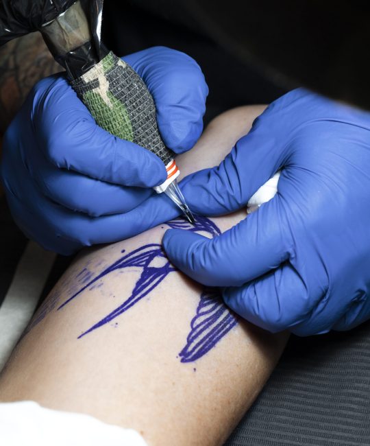 Laser Tattoo Removal in Columbia, MD